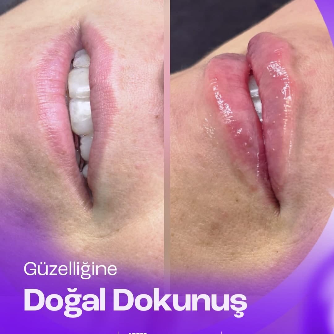 Dudak dolgusu öncesi ve sonrası — doğal dokunuş