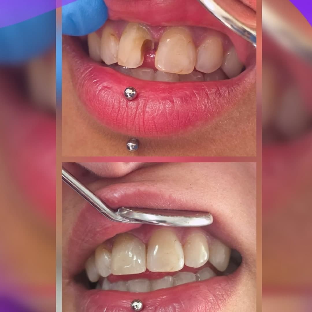Kırık ön diş restorasyonu öncesi ve sonrası