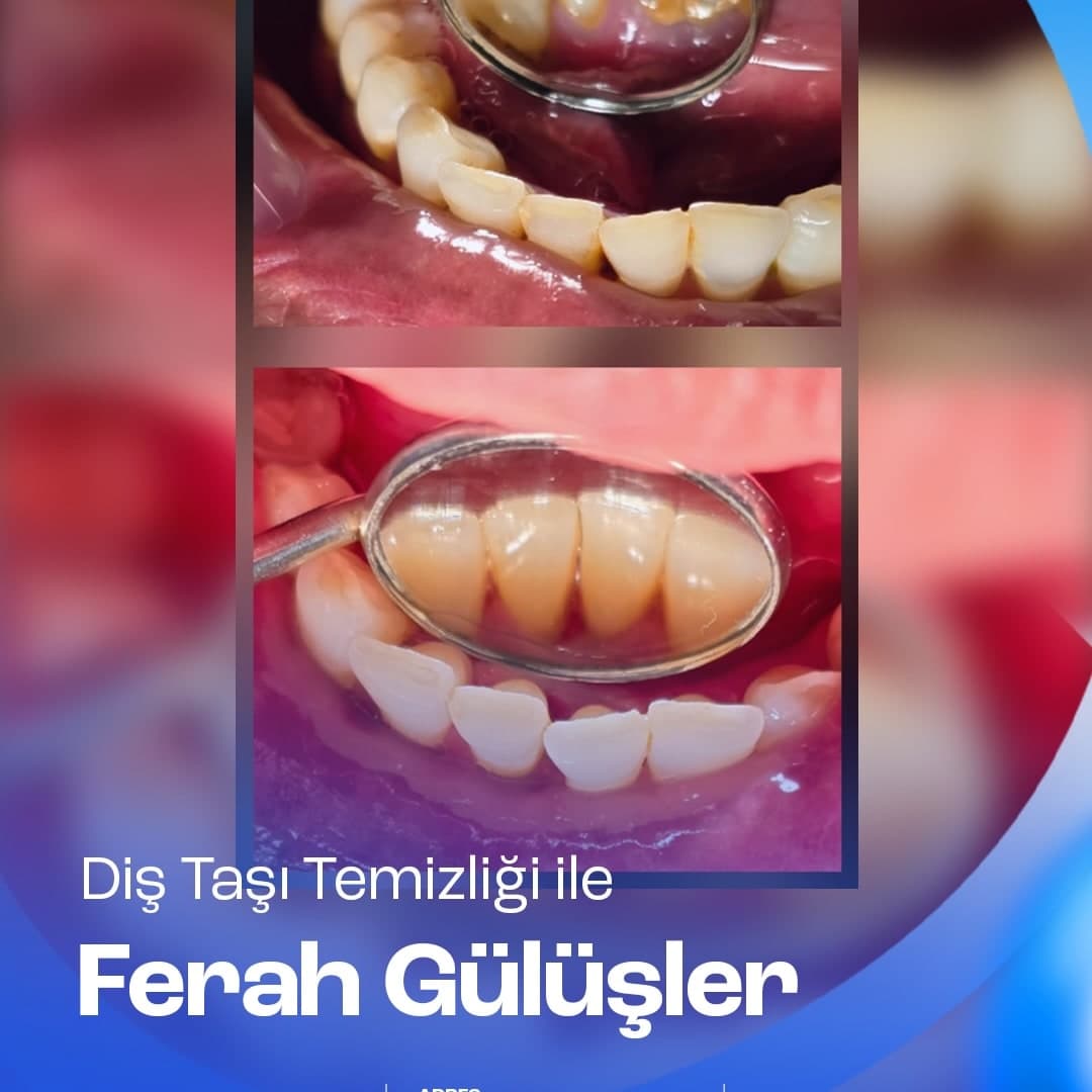 Diş taşı temizliği öncesi ve sonrası