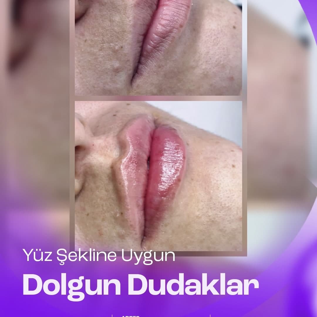Dudak dolgusu ile yüz şekline uygun hacim