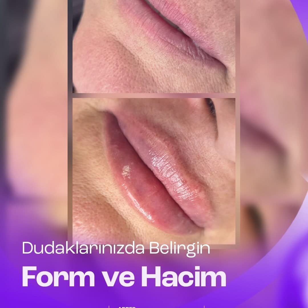 Dudak dolgusu ile belirgin form ve hacim