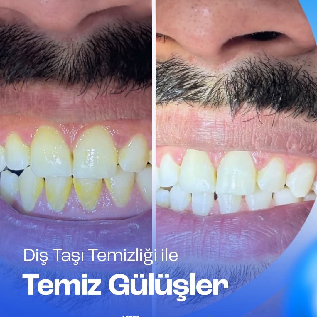 Diş taşı temizliği öncesi ve sonrası